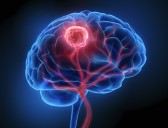 Bacteria Inside Brain Tumors Could Affect How They Behave