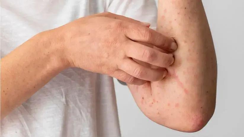 Canadá deja de ser un país libre del sarampión tras brote que ha provocado 5100 casos