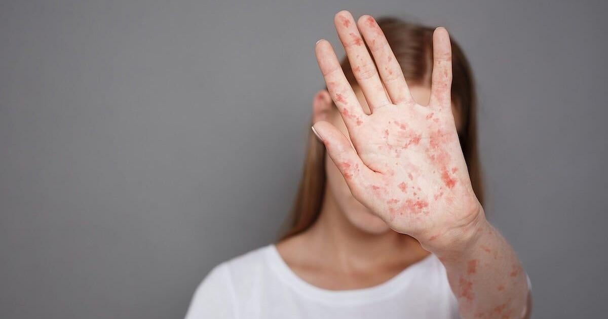 New Measles Spread Across States Threatens U.S. Elimination Status