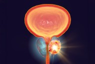 Thyroid Hormone Receptor TRβ Identified as New Target for Prostate Cancer Treatment