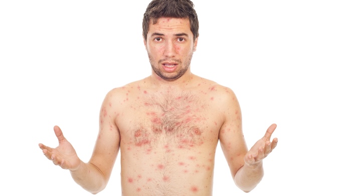 Cómo protegerse de la Viruela del Mono o mpox