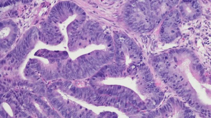 Descubren cómo el cáncer de colon se vuelve 'invisible' a la inmunoterapia