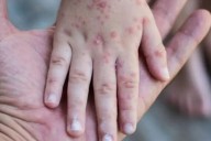 Coxsackie en Hidalgo: Este es el llamado de la SSH ante la presencia del virus