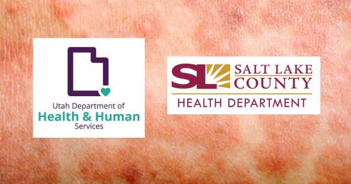 Race on to ID people in contact with first confirmed measles patient in SLCo