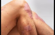 Oral IL-23 Receptor Blocker Icotrokinra Significantly Improves Skin Clearance in Plaque Psoriasis:...