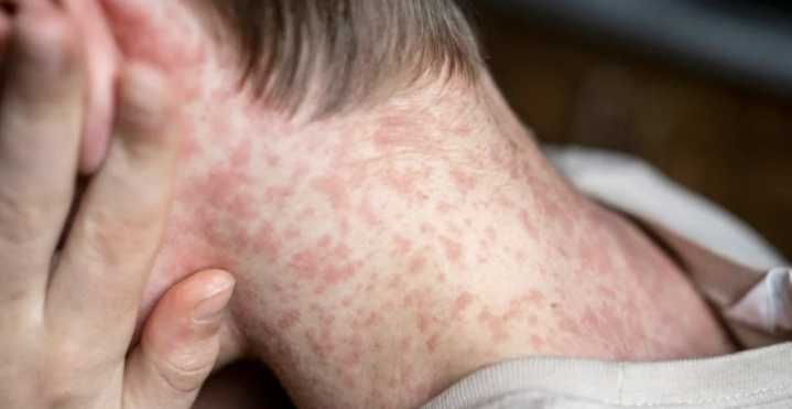 México reporta 74 casos activos de sarampión; hay 441 personas en fase de confirmación