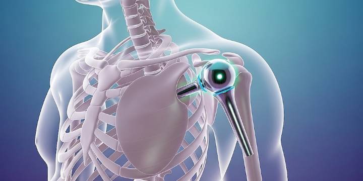 La obesidad no supone barreras para la cirugía de reemplazo de hombro, según un estudio