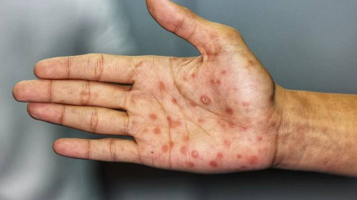 Crecen los contagios de sífilis en Buenos Aires: Esteban Echeverría refuerza los testeos y la prevención