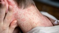 Letal en niños y embarazadas. Un experto analizó el alerta sanitaria por sarampión y reveló “la única manera” para evitar una epidemia en el país