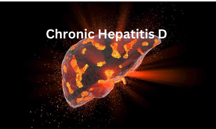 Dual Therapy Shows Antiviral Activity in Chronic Hepatitis D Patients: NEJM