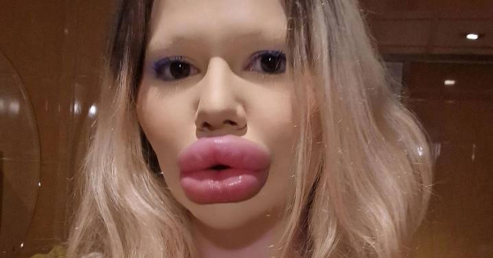 Woman with 'world's biggest lips' is refused filler by doctors