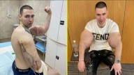 El "Popeye ruso": Influencer se inyectó vaselina en los bíceps y ahora podría perder ambos brazos