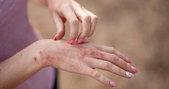New eczema treatment to be made available on NHS