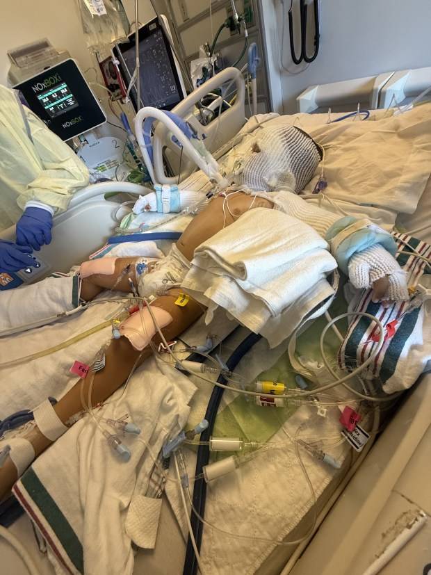 3-year-old Morgan Hill boy recovering from burns after fire pit explosion