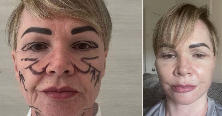 Scots woman left with 'hearing loss' and 'lopsided mouth' after botched facelift in Lithuania