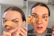 Woman Has Rhinoplasty, She Can’t Believe What She Notices 1 Week Later