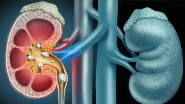 The Lancet: 15.4% de adultos con enfermedad renal crónica