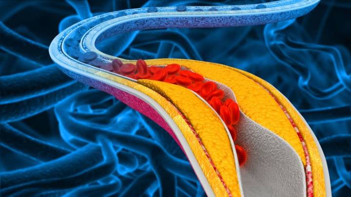 Experimental daily pill may lower cholesterol in patients who don’t see enough benefit with statins alone, study finds