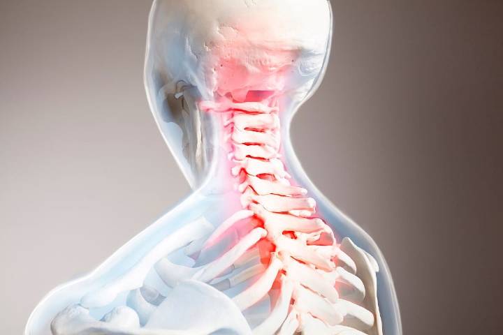 Long-Term Morbidity, Mortality Increased After Traumatic Spinal Cord Injury