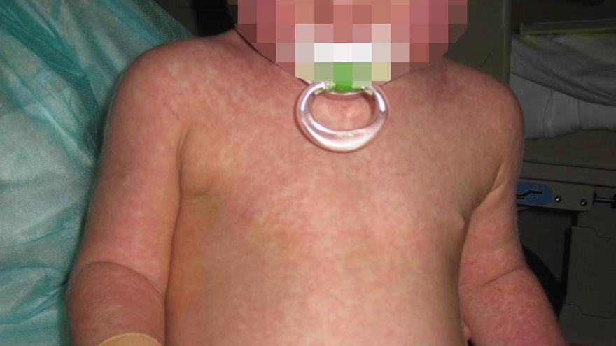 Las altas coberturas vacunales contienen la expansión descontrolada del sarampión en Canarias