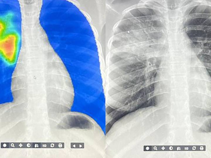 AI steps in to detect the world's deadliest infectious disease