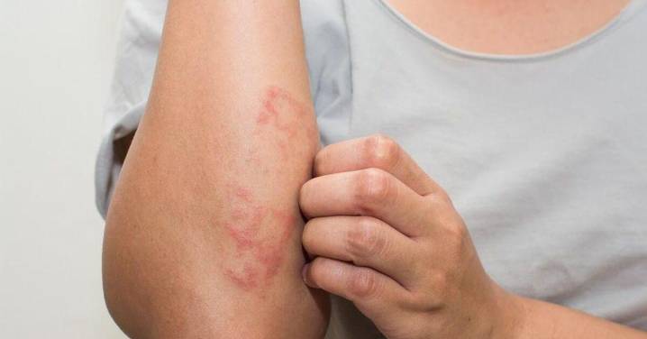 Los casos de sarna detectados en Atención Primaria se multiplican por 50 entre 2011 y 2023