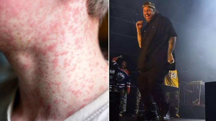 Queensland Health warns of possible measles outbreak after infectious fans attend Jelly Roll concert in Brisbane
