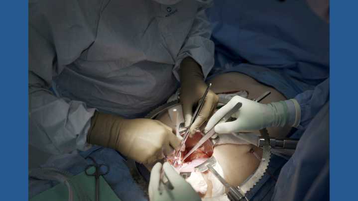 First clinical trial of pig kidney transplants gets underway