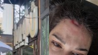 Joven denuncia agresión en bar Bambú Manacar en Benito Juárez; sujeto la golpeó con un tarro en la cabeza