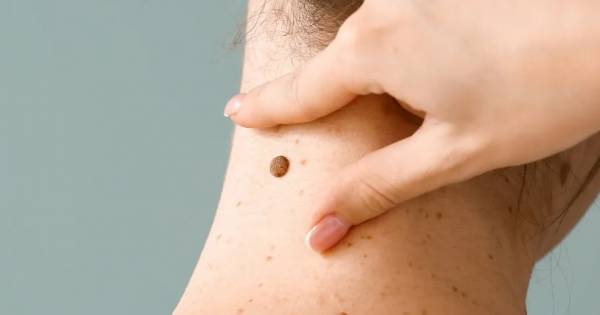 Cómo actúa Vaccimel, la nueva vacuna argentina contra el cáncer de piel