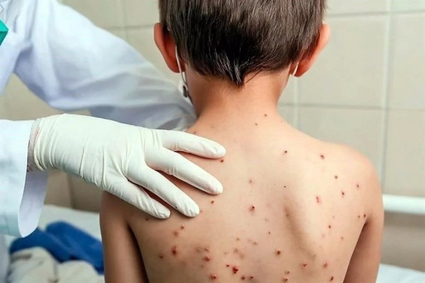 Alerta a OPS brote de sarampión en México