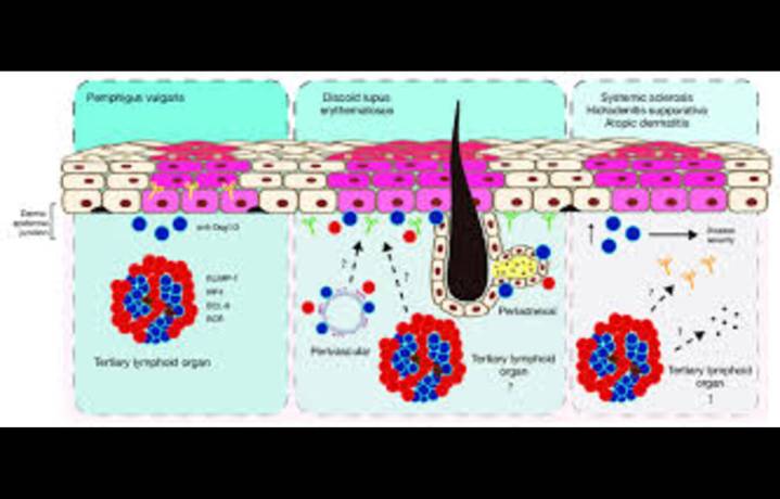 High Tyrosine and Phenylalanine Intake Linked to Greater Severity of Pemphigus vulgaris: Study