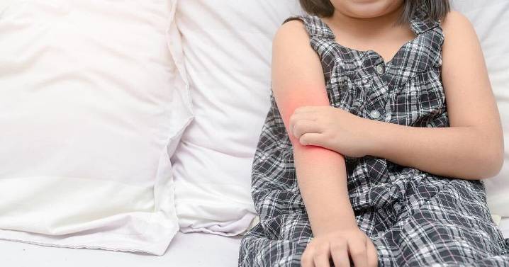 COVID Vaccine Offers Health Boost For Kids With Eczema