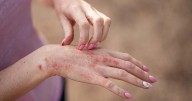 New eczema treatment to be made available on NHS