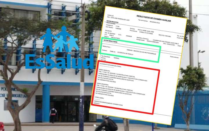 ¡OTRA VEZ! Paciente de Essalud se hace examen de rodilla y le entregan “ecografía de mama"