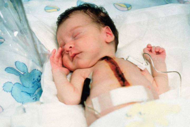 In 1984, Doctors Made History By Transplanting a Baboon's Heart Into a One