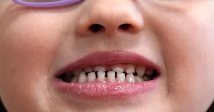 FDA restricts use of kids' fluoride supplements citing disputed health risks