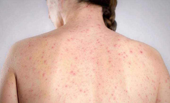 La OPS anunció que América no es más una región libre de sarampión