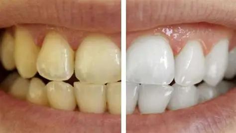 Cómo hacer blanqueador de dientes casero