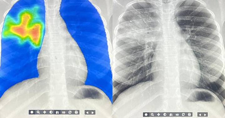 AI steps in to detect the world's deadliest infectious disease