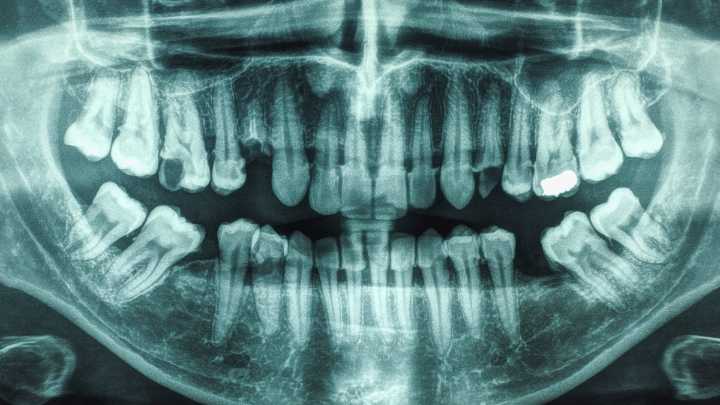 21-Year Study Links Gum Disease And Cavities to Higher Stroke Risk