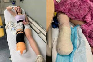 Local teen with cancer gets devastating news after her foot was amputated. How she is staying positive