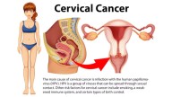 A Preventable Cancer Is Killing A Woman Every Two Minutes - UN Sounds Global Alarm On Cervical Cancer Crisis