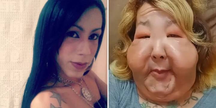 Una influencer brasileña inicia un tratamiento de recuperación tras un procedimiento estético clandestino