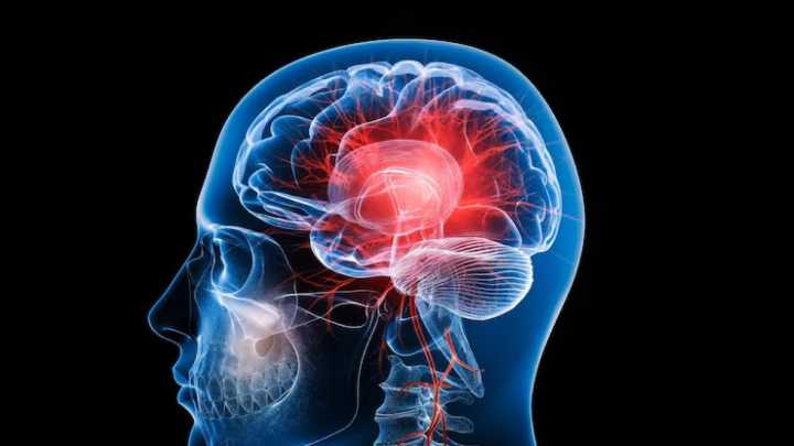 Aragón registra 3.000 ictus al año: el 80% se puede prevenir con hábitos muy sencillos