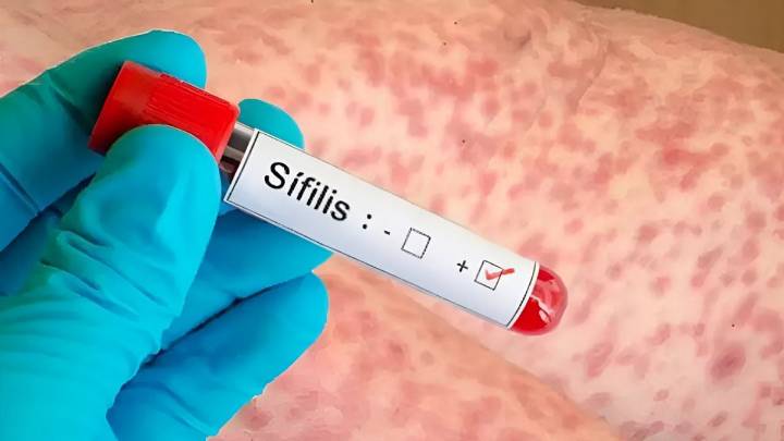 Preocupación nacional por el gran aumento de casos de sífilis en personas menores de 40 años