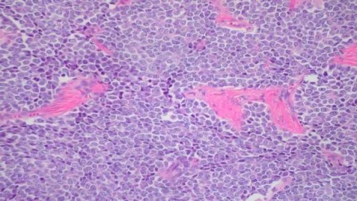 Identifican la célula que origina el Sarcoma de Ewing, un tumor pediátrico muy agresivo