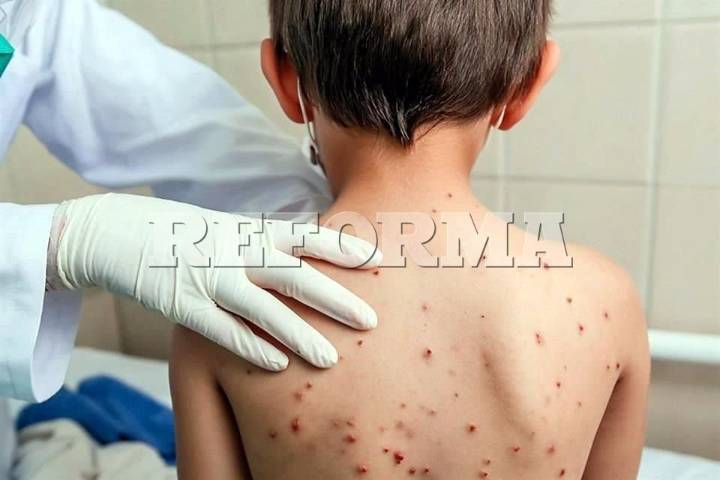 Confirma Ssa 23 muertes  por sarampión en México