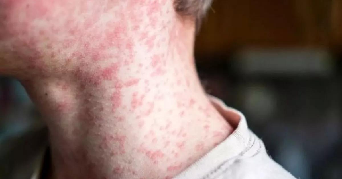 Everything you need to know as cases of measles spread in Greater Manchester