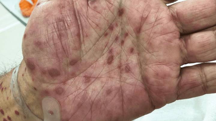 Entre Ríos: en 2025 los casos de sífilis aumentaron 72%